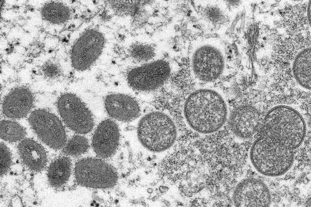 Halton Region confirms first case of monkeypox, eight cases confirmed in Toronto